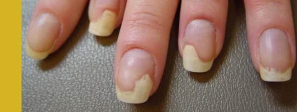 отслаивающиеся ногти, болезни по ногтям
